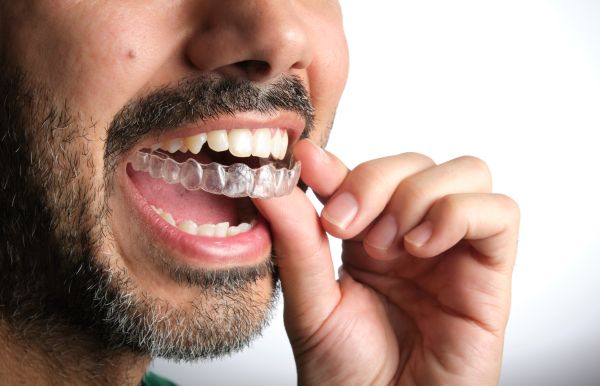 How Do Clear Aligners Work For Teeth Straightening?