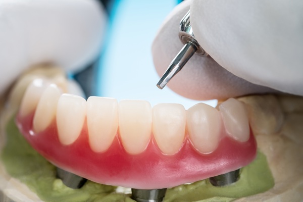 Fixed Vs Removable Implant Supported Dentures