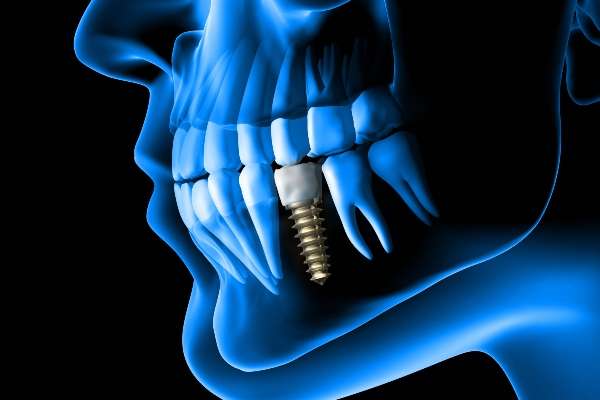 What To Expect During The Dental Implant Procedure